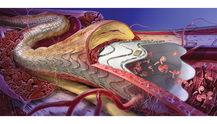 Pad Gore Launches Post Approval Study Of Viabahn Stent Graft Massdevice